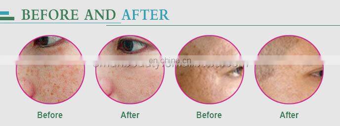 Tendencia buy_derma_roller derma roller needle 0.5 mm derma roller skin rejuvenation