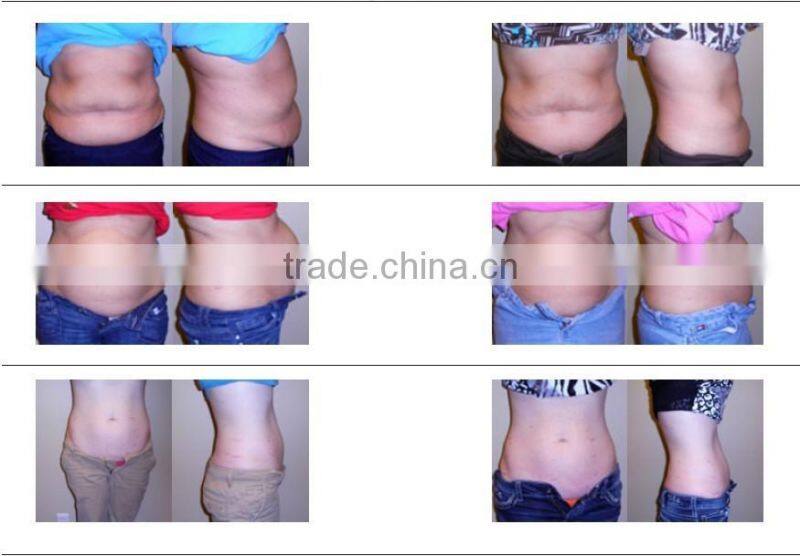 lipo laser cavitation