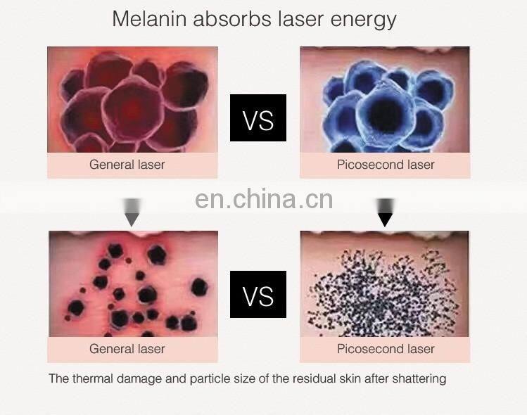 The most popular Tattoo Removal Picosecond Laser