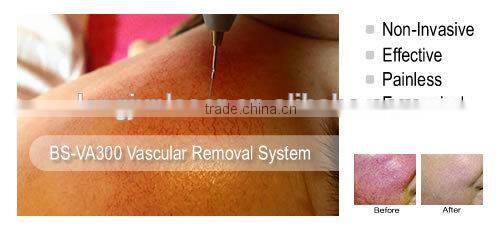 Spider Vein Removal Vasular Vein Removal Face Clearance Machine