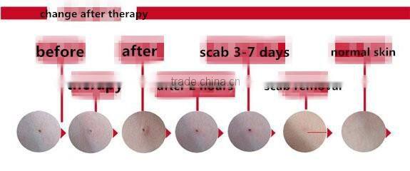 Metal Laser spot skin mole removal machine with 12pcs needles