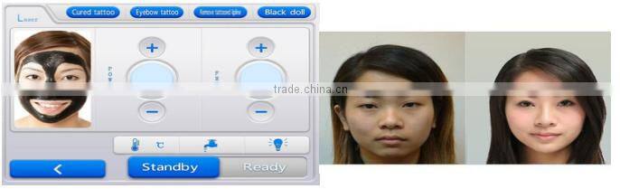 2016 china laser beauty equipment Q-switched nd yag laser tattoo removal 1320nm black doll for salon use