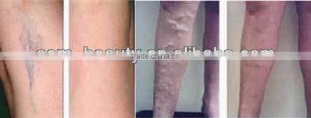 2014 super Cooling systern Nd Yag Laser Hair Removal / Long Pulse Laser Hair Remover MachinesP003
