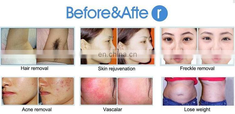 Best Selling Cheap Strong Pulse Light Ipl Laser Hair Removal Device Home Use