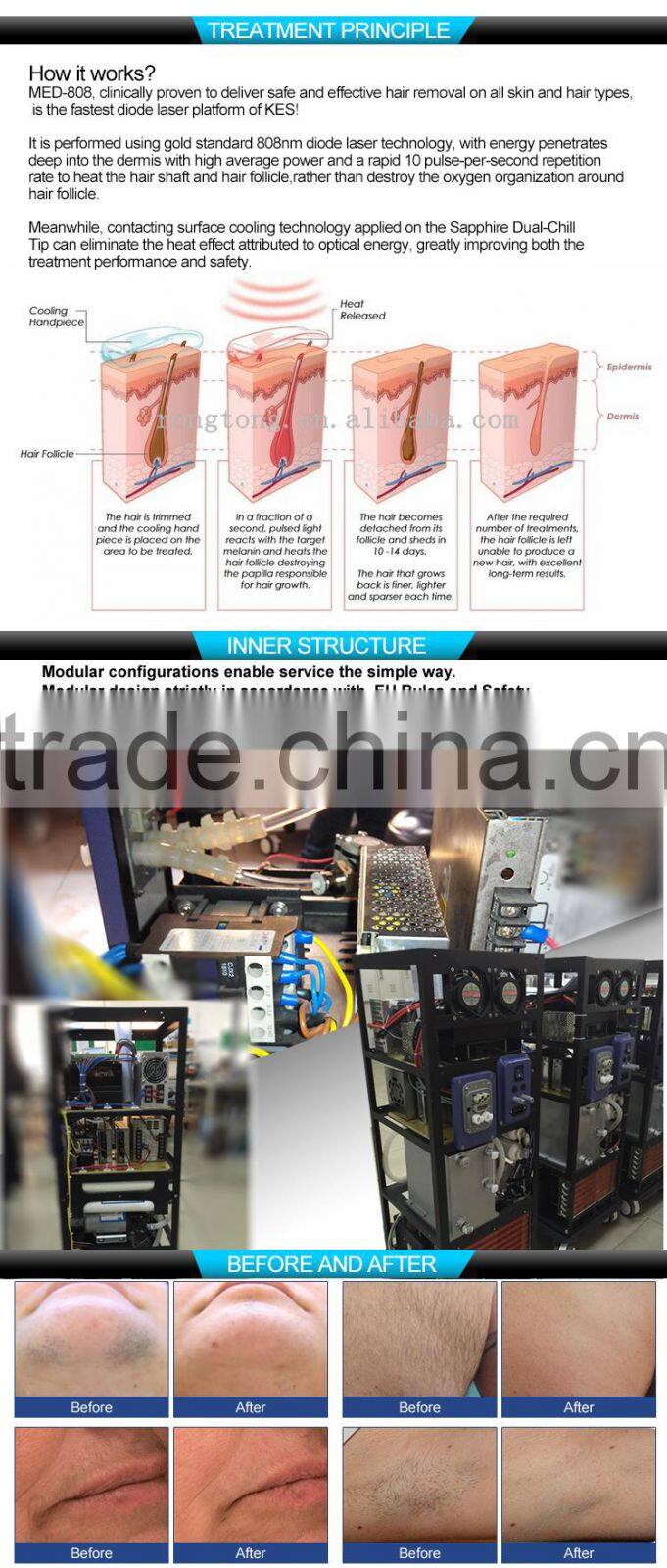 808nm diode laser permanent hair removal machine med-808