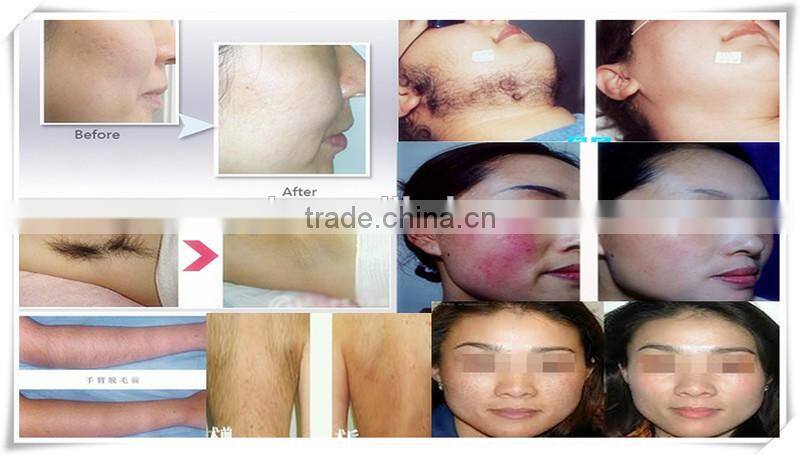 Guranteed RF+IPL equipment 5mhz beauty spa instruments