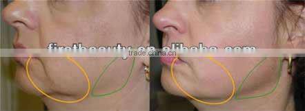 2014 newest rf machine with high-tech humanized design for skin lifting