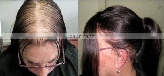 Low level laser hair growth helmets 650nm hair growth led light and Fda