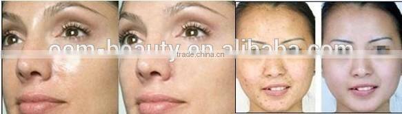 High power q switch nd:yag laser tattoo removal machine