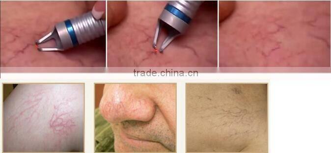 hot sale 980nm spider vein removal and vascular removal multifunction equipment