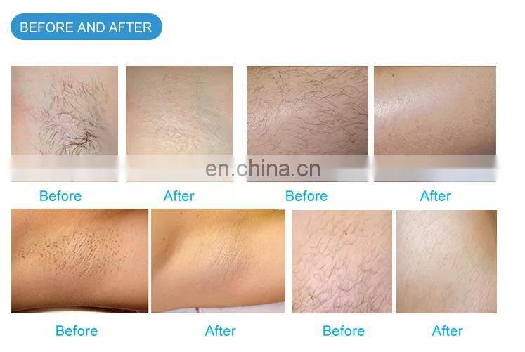 2022 New Arrival Diode Laser 808nm Depilacion Laser Diodo 808nm Wavelength