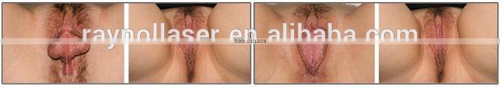 2017 Vaginal Tightening Machine China Supplier 5000 Times HIFU for Sale