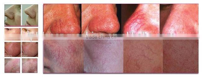 Manufacturers looking for Distributors/FDA Approved High Frequency Laser Spider Vein Removal Beauty Salon Equipment