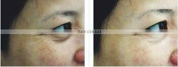 IPL hair removal & 100000shots body hair removal ipl device A003