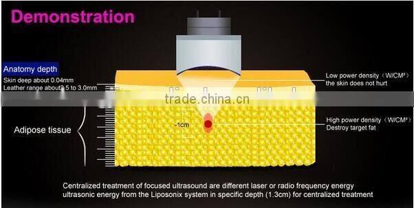 Professional Face Lift Hifu Ultra Slimming Machine With Liposonix