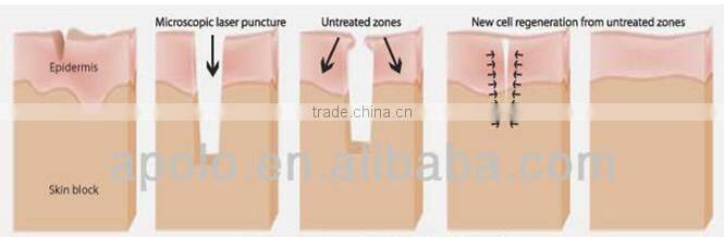 1540nm Er Glass Fractional Laser machine for wrinkle removal scar removal by Shanghai Apolo