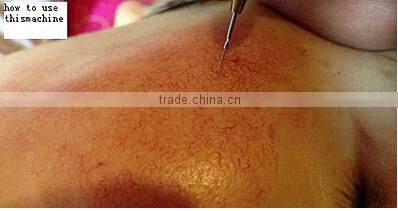 2016 Alibaba Thailand RBS spider vein removal beauty machine for sale
