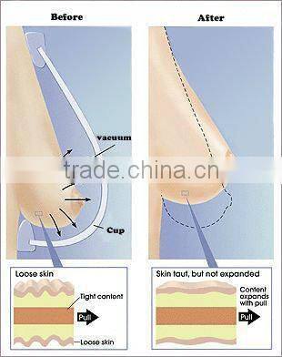 H-2018 Breast lift up pump cupping suction machine for massage