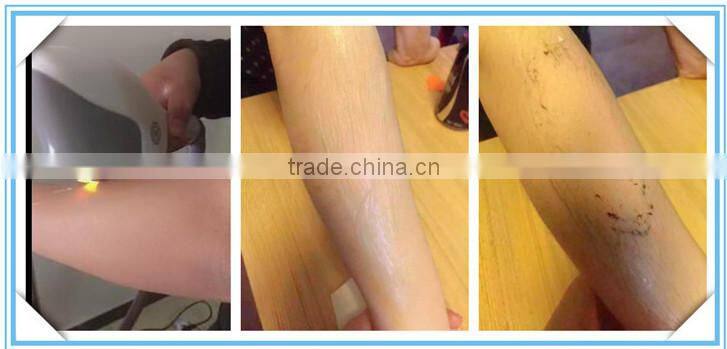 ipl laser hair removel epilation machine lumenis price for sale with ce