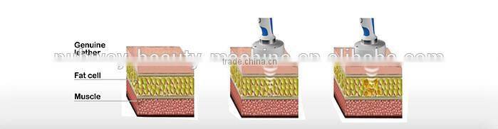 New Product High Intensity Focus Ultrasound HIFU for body slimming