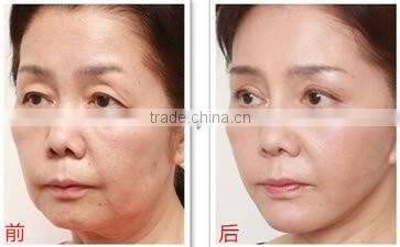 New Designed Bipolar RF Skin Tightening Face Lifting Beauty Equipment Price