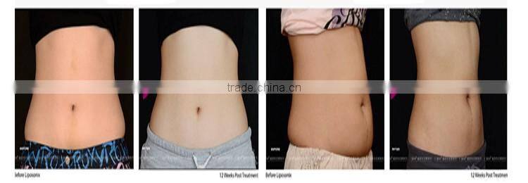 Merry christmas! professional high intensity focused ultrasound slimming weight balance lipo hifu machine