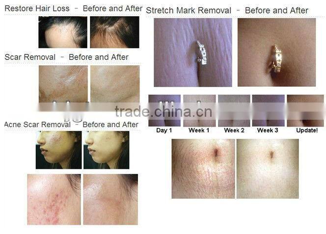 Free sample ! 2013 newest derma roller for hair loss treatment,titanium hair roller