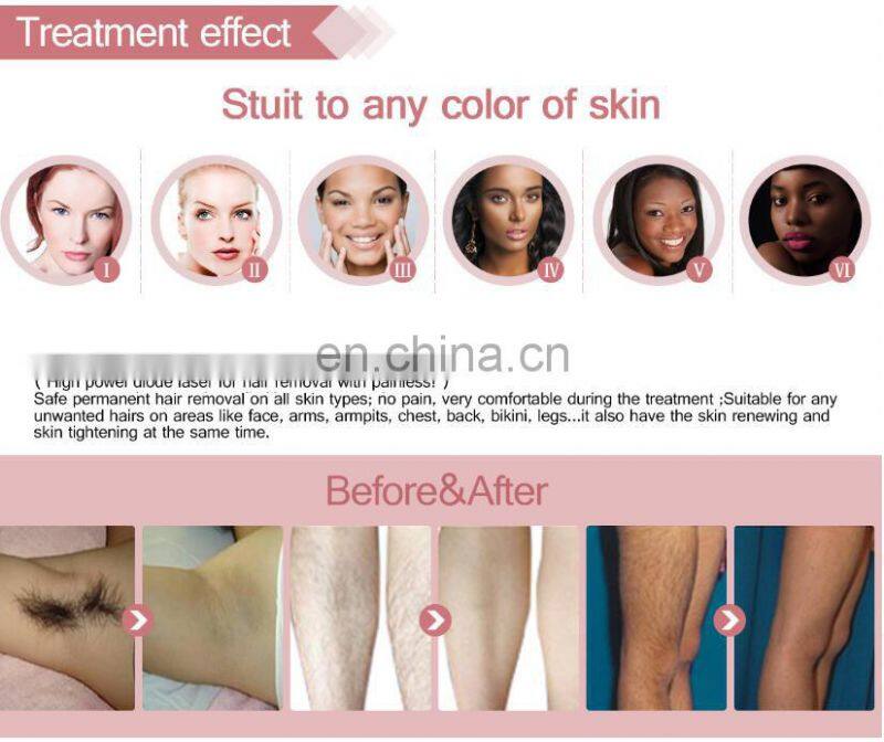 Lumenis Lightsheer et 808nm Diode Laser Machine for hair removal 755 808 1064