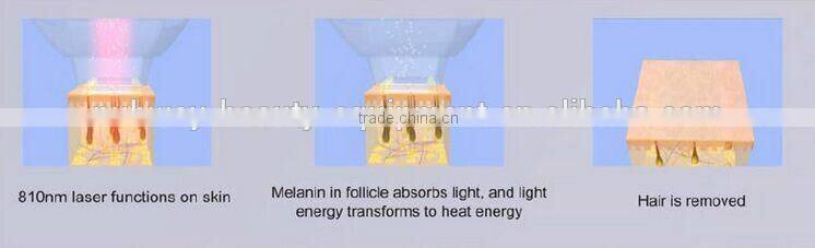 permanent body hair removal diode laser hair removal system