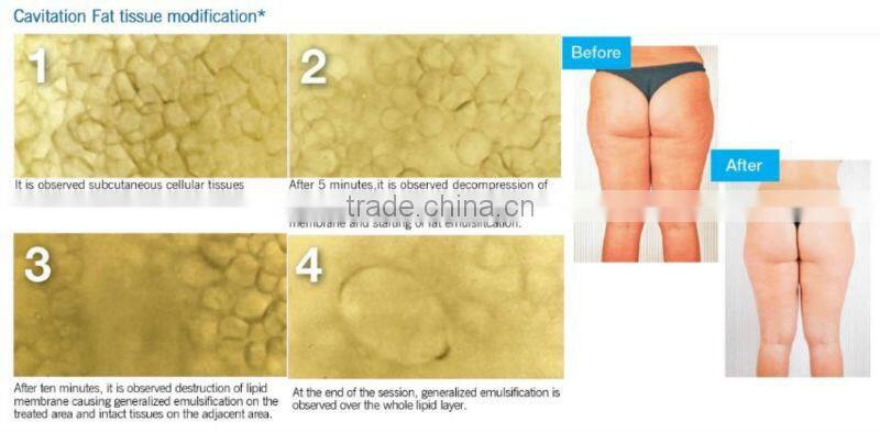 cellulite weight loss HS 560v+ weight loss equipment by shanghai med apolo