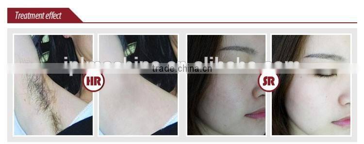 Hot selling hair removal device home use