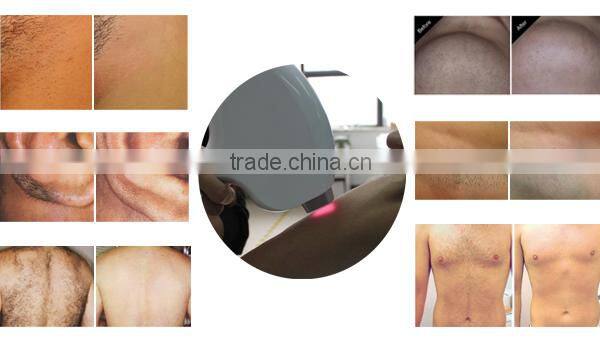 Newly designed most advanced professional vertical 808nm diode laser hair removal skin spa medical device