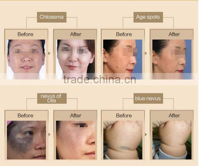 2016 Melasma Age spots tattoo removal cream laser tattoo removal machine price