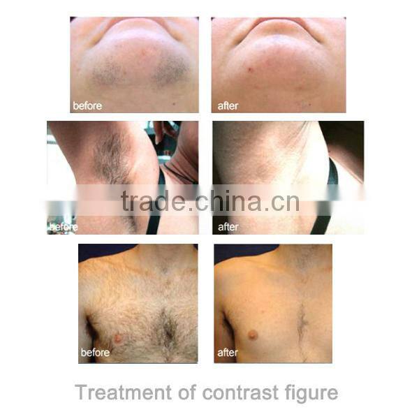 gglt diodo 808 laser hair removal system 808nm diode laser hair reduction equipments