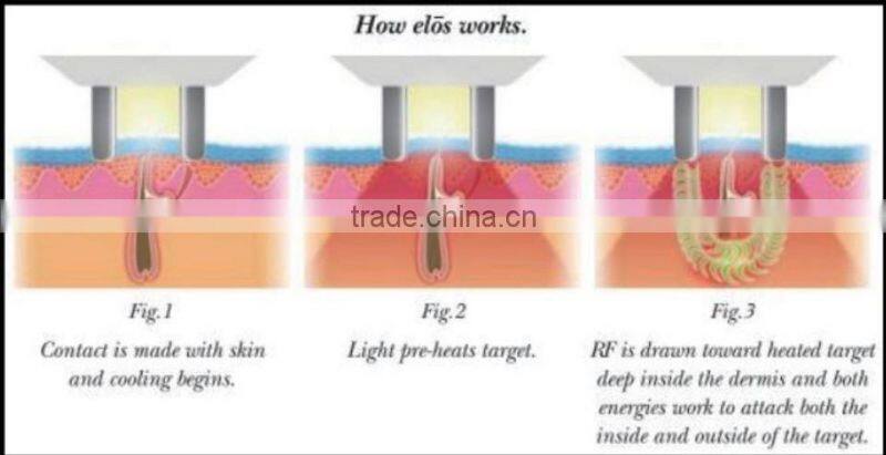 New Arrival alma laser hair removal machine for sale