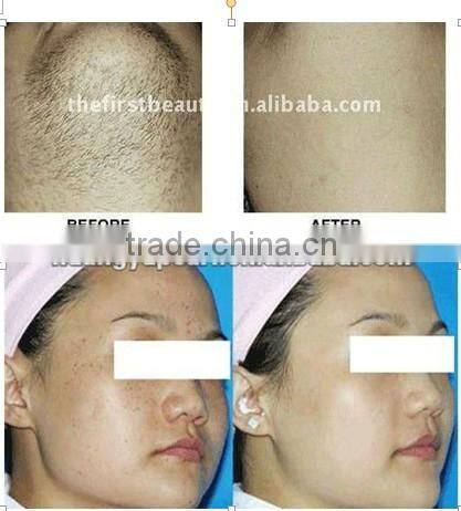 2014 super Cooling systern Nd Yag Laser Hair Removal / Long Pulse Laser Hair Remover MachinesP003