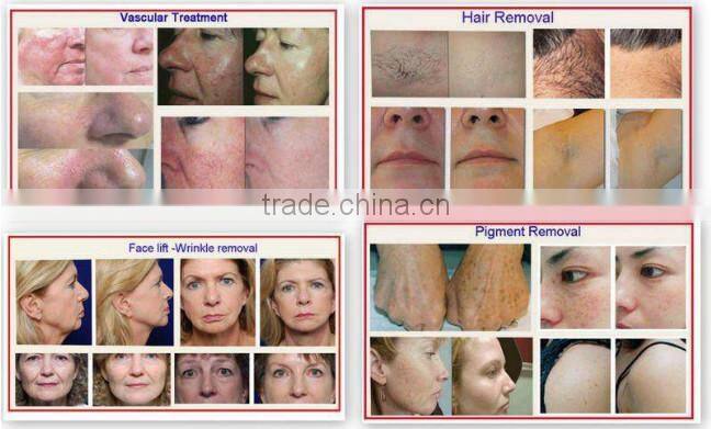 good market for ipl shr Elight nd yag pore removal laser with long pulse 1064nm