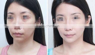 face body wrinkle removal multi-channel RF key-330 machine