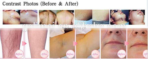 skin rejuvenation ipl machine made in germany