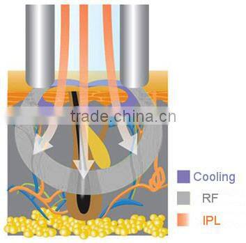 zhejiang yiwu ipl e-light beauty machine Manufacturer