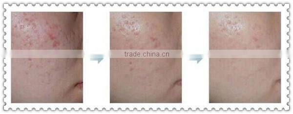 Allfond hot selling portable mesotherapy guns