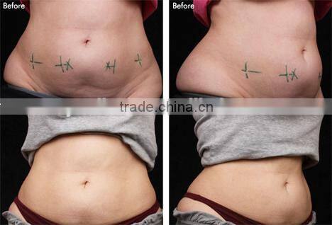 Advanced Vacuum Cryolipolysis Professional CE Two Handles Cryo Fat Freeze Slimming Beauty Machine