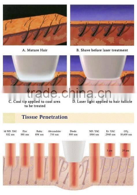 808nm laser hair removal / laser diode / 808 diode laser