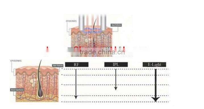 laser multifunction e-light+laser for hair removal and tatoo removal