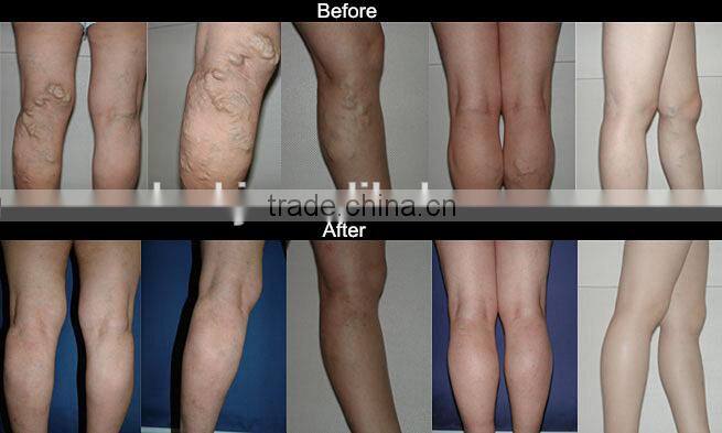 1064nm long pulse Q-switch nd yag laser equipment for spider veins