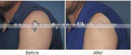 Soft Laser Machine Tattoo Removal Machine with infrared light D006