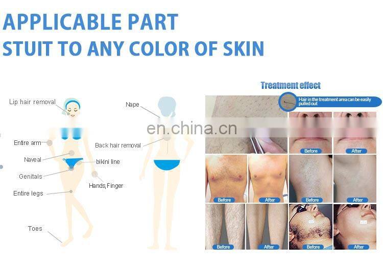 High output power 1200W / 1000W / 800W / 600w 755 808 1064 triple wave laser hair removal