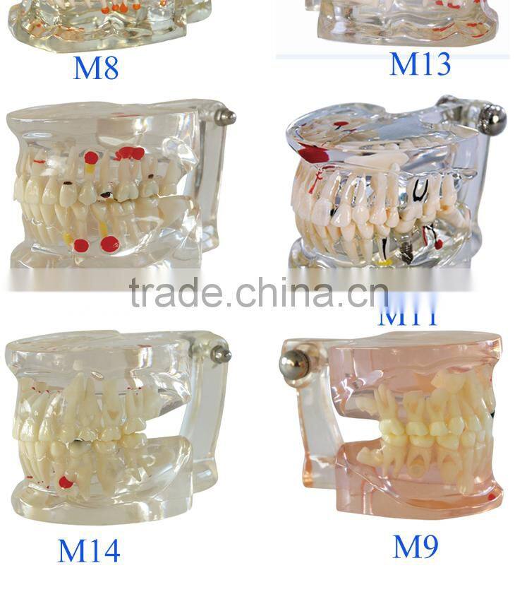 Popular Transparent Plastic Pathologic Dental Implant Model for study