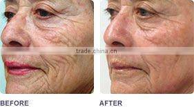 Super E-light hair removal beauty system with TGA certificate