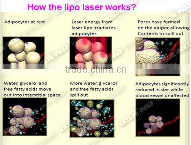 Total 88 pcs Mitsubishi diode laser light lipo laser weight loss machine